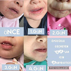 SIANI BabyBiotics cradle cap close-up on a child's scalp