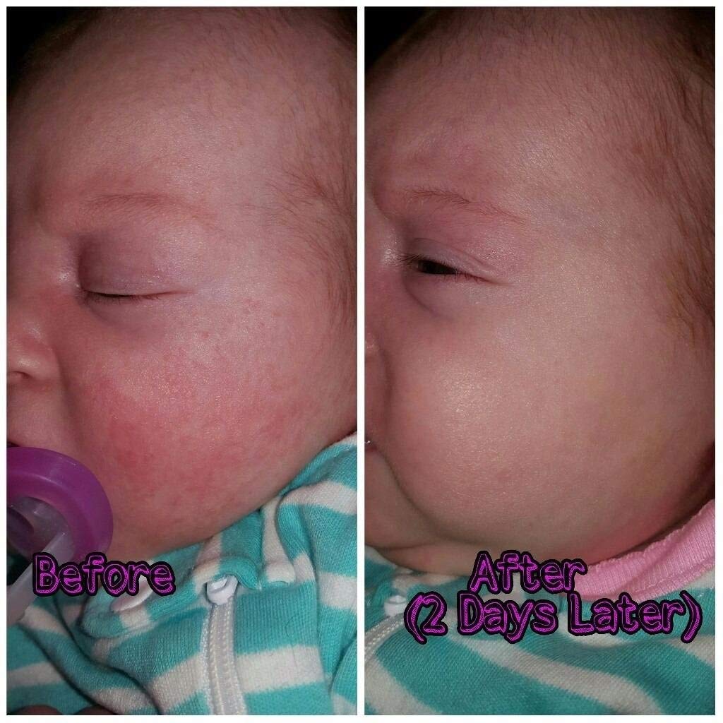 SIANI BabyBiotics hand foot mouth use on exposed skin areas