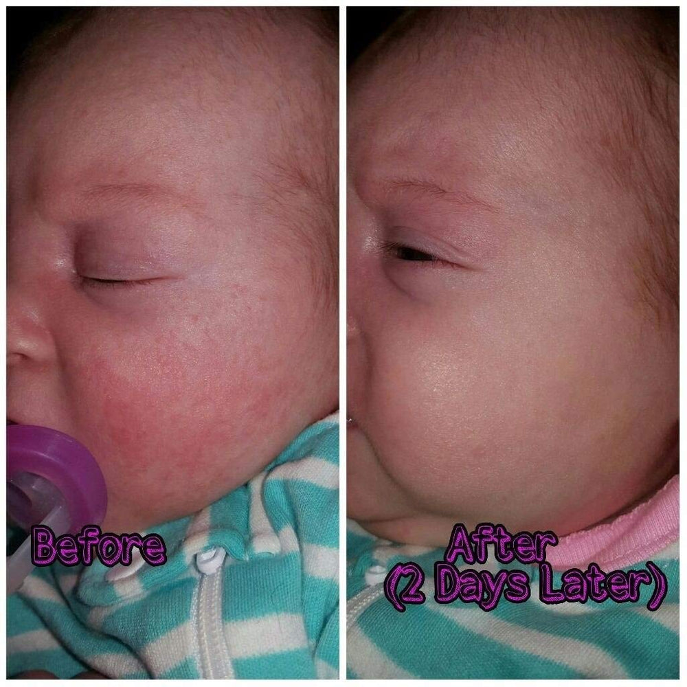 SIANI BabyBiotics hand foot mouth use on exposed skin areas